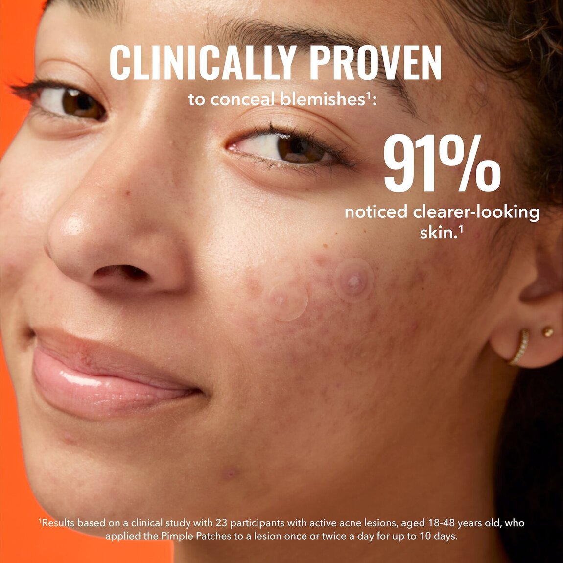 pimple-patches-z1 zb_p.jpg